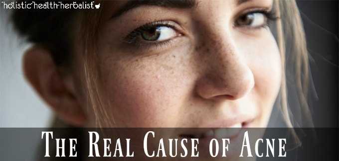The Real Cause of Acne - girl with clear skin