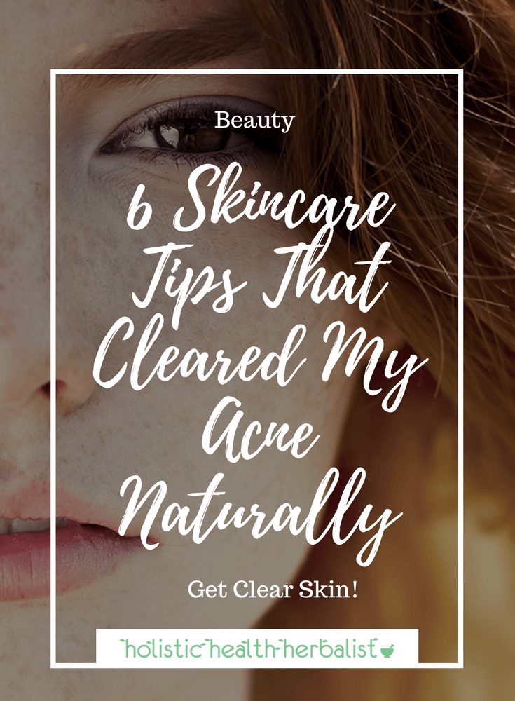 6 Skincare Tips That Cleared My Acne Naturally- Learn about my top acne remedies that will get your skin clear fast! #acne #skincare #beauty #clearskin