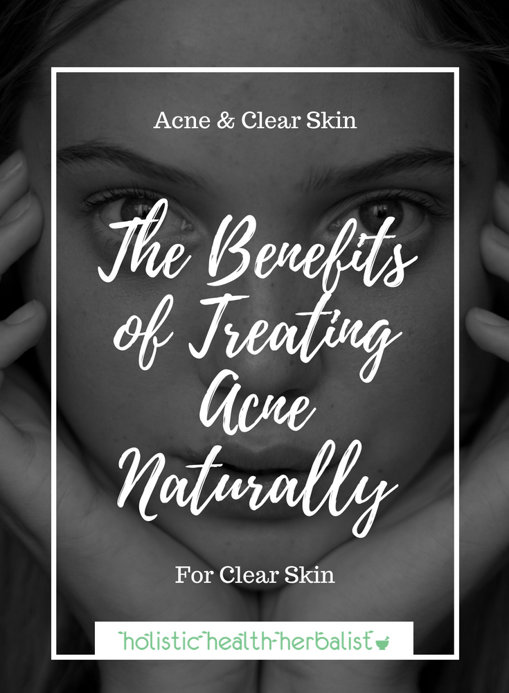 The Benefits of Treating Acne Naturally and A Little Story - Learn how I came to the crunchy lifestyle in order to regain my health and clear my acne naturally.