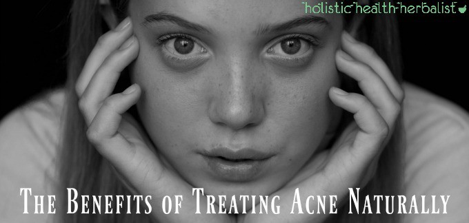 The Benefits of Treating Acne Naturally - A Little Story