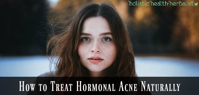 How to treat Hormonal Acne Naturally