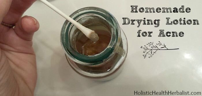How to make a homemade drying lotion for acne prone skin.